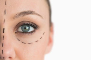 Lifting Sylvie Vartan Aujourd'hui